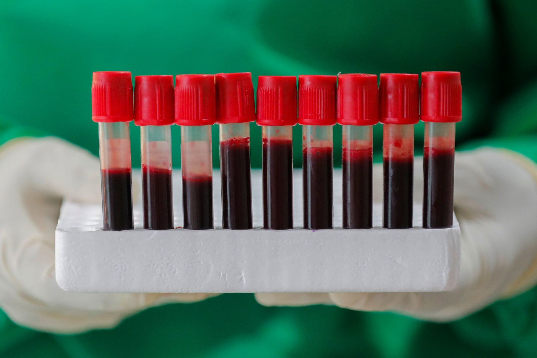 Blood Type A is Common in COVID-19 Cases, Study Suggests
